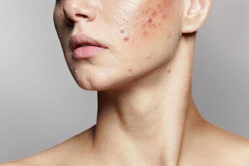 acne scar RF microneedling