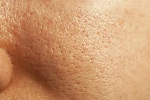 enlarged pores