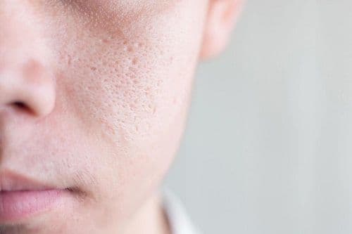 enlarged pores