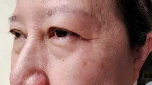 eyelid edema