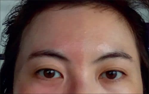 皮膚發紅問題