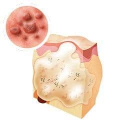暗瘡形成與處理
