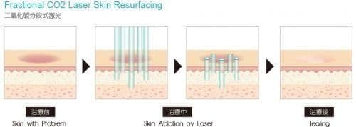 Fractional Co2 laser