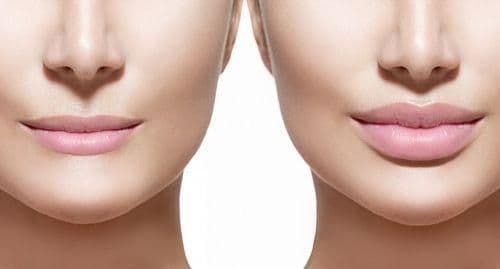 lip augmentation