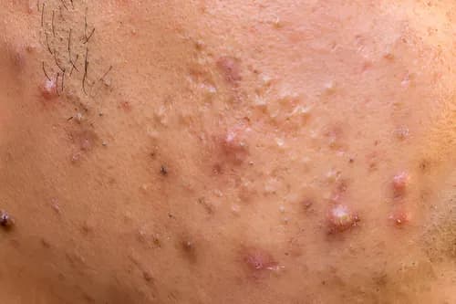 nodular acne