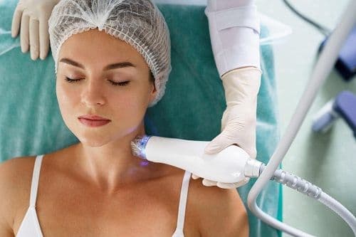 RF microneedling