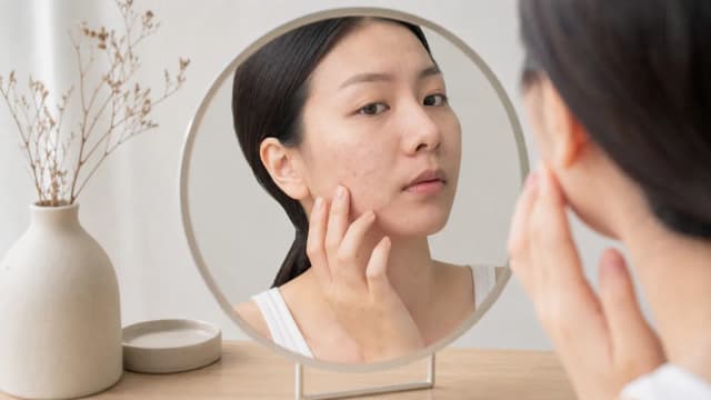 Editorial image for A Comprehensive Guide to Understanding and Treating Acne Scars: From Prevention to Advanced Solutions