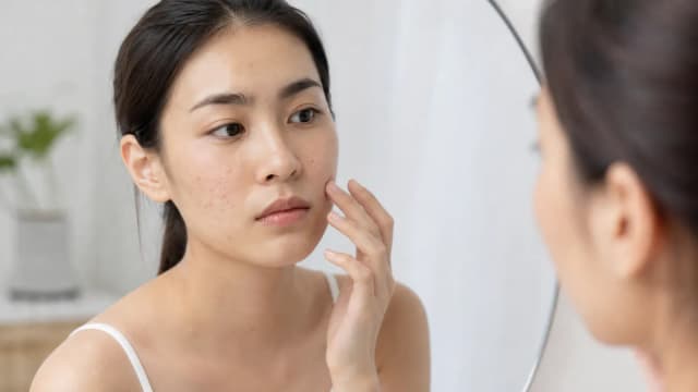 Editorial image for Acne and Its Relationship with Skin Color: Let’s Address Skin Issues Correctly