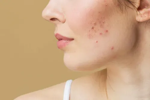 acne