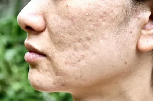 acne scar