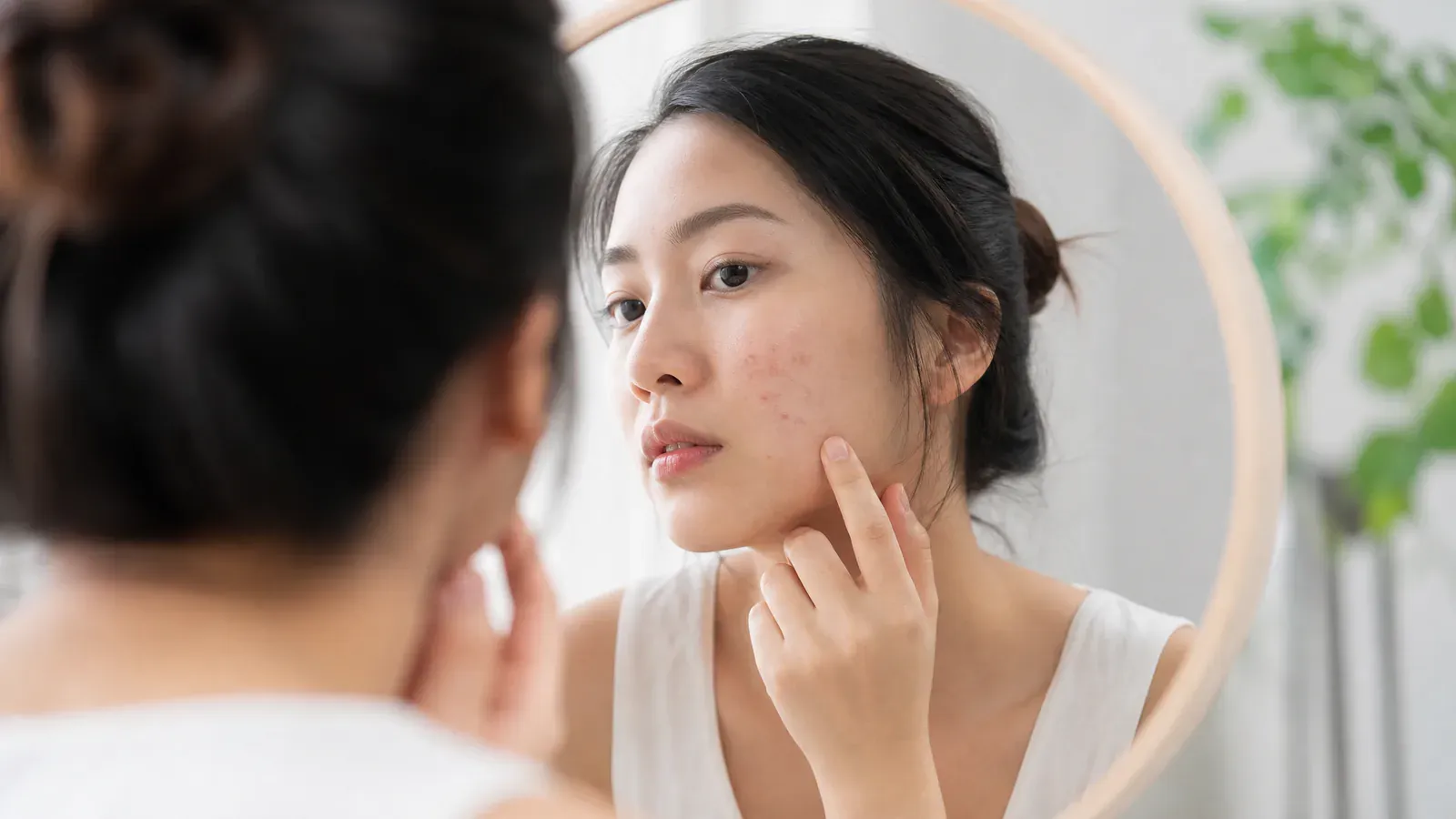 “痘痕:如何有效地预防它们”的专题图片