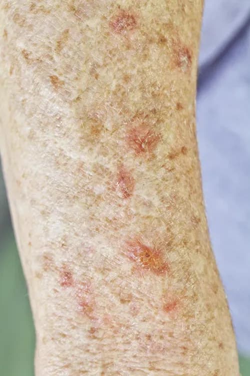 actinic keratosis forehearm