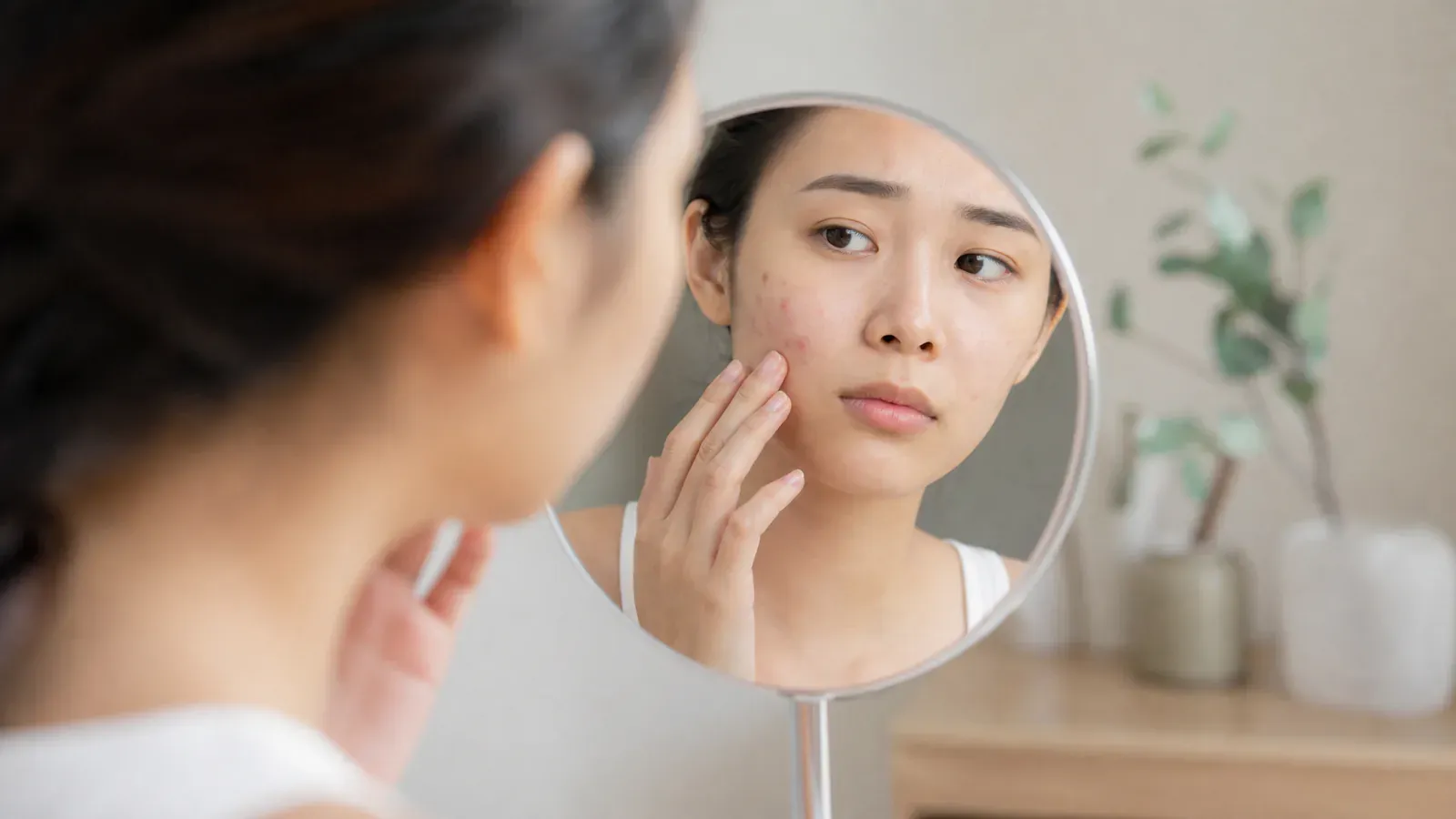 Editorial image for Causes of Acne Recurrence and Coping Strategies