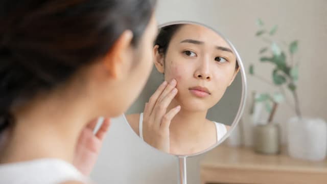 Editorial image for Causes of Acne Recurrence and Coping Strategies