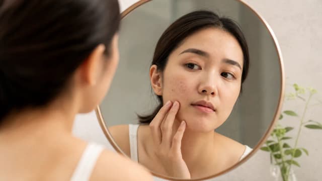 Editorial image for How to Effectively Prevent Acne Scarring and Pigmentation Issues