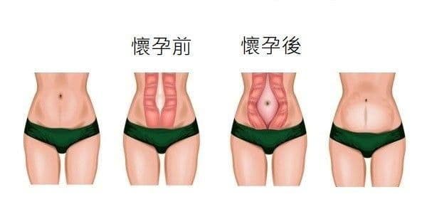腹直肌分離症