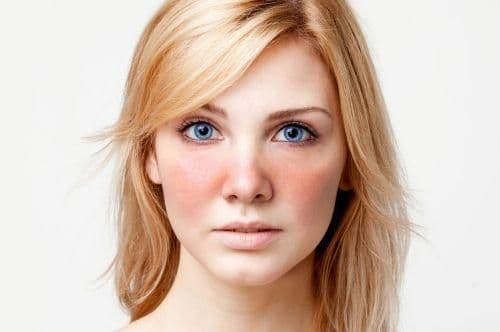 rosacea