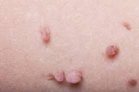 skin tag