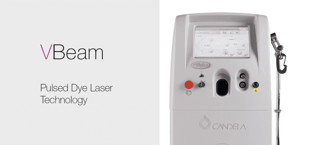 vbeam