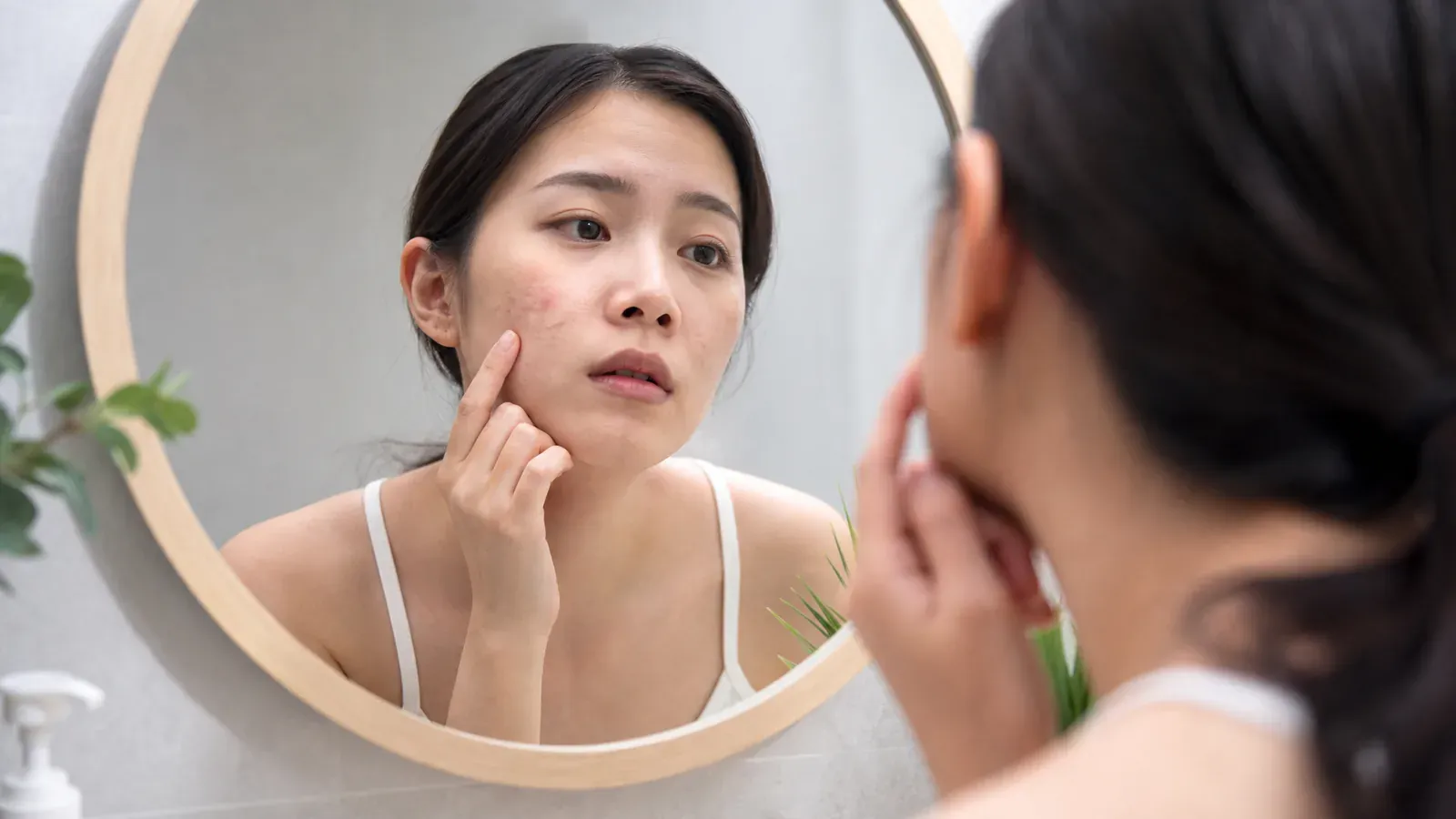 「暗瘡的管理與護理:改善肌膚之道」的專題圖片