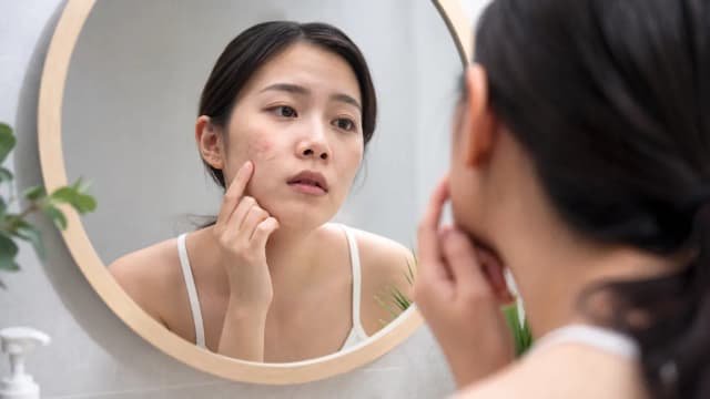 Editorial image for Management and Care of Acne: Ways to Improve Skin Health