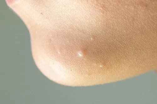 molluscum contagiosum