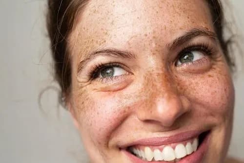 pigmentation