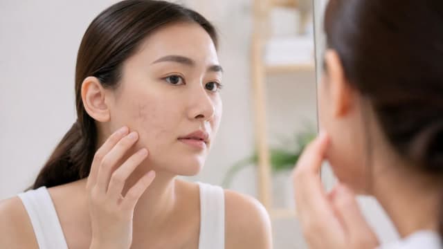 Editorial image for Quick Solutions for Acne Scars: Exploring Effective Treatments and Techniques