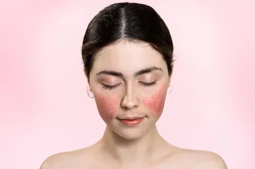 rosacea