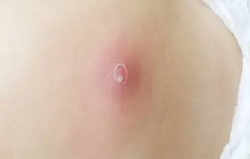 skin abscess
