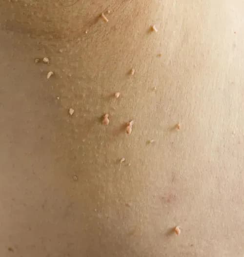 skin tags