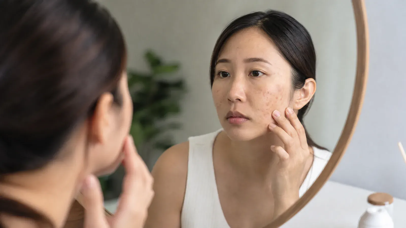 Editorial image for Treating Post-Inflammatory Hyperpigmentation (PIH) Scars: Effective Solutions and Techniques