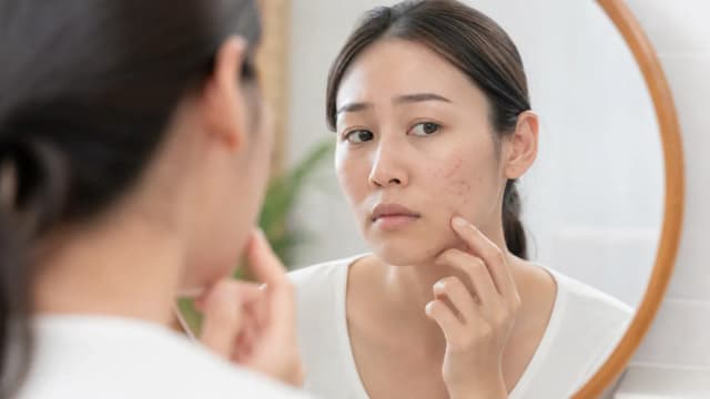 Editorial image for Understanding Acne Excoriée: Addressing the Compulsion to Pick for Healthier Skin and Emotional Well