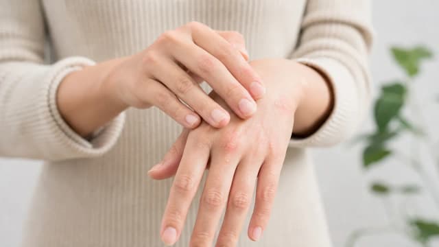 Editorial image for Understanding Dyshidrotic Eczema: Causes, Symptoms, and Treatment Options