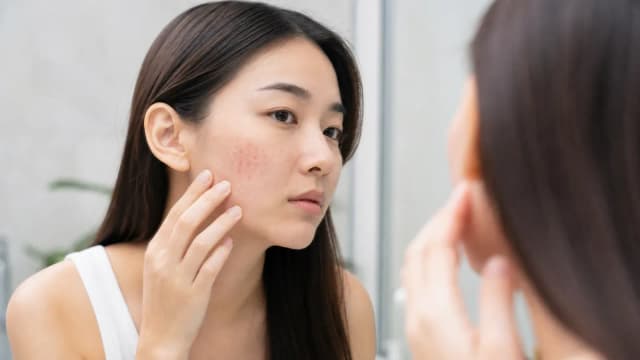 Editorial image for Understanding Keratosis Pilaris: Causes, Treatments, and Skin Management for Red Bumps on the Face