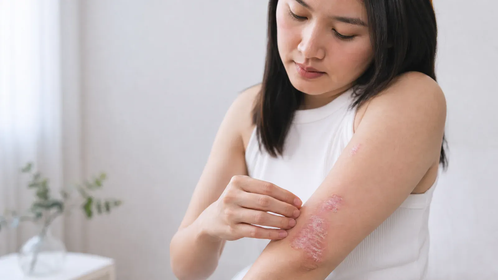 “了解银屑病:症状、原因及治疗选择”的专题图片