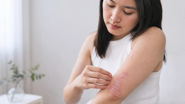 Editorial image for Understanding Psoriasis: Symptoms, Causes, and Treatment Options