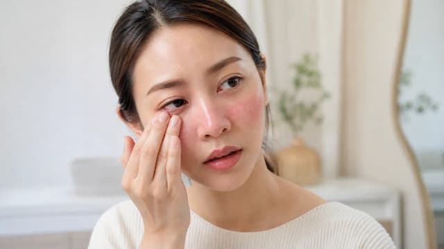 Editorial image for Understanding Rosacea and Ocular Health- Navigating Ocular Manifestations and Effective Interventions
