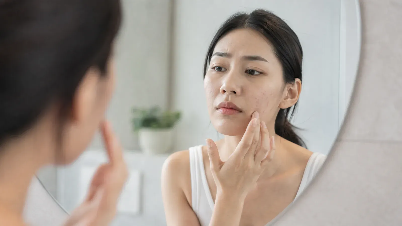 Editorial image for Unlocking the Secrets of Adult Acne: Understanding the Differences Between Acne and Adult Acne and Their Underlying Health Issues