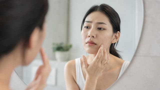 Editorial image for Unlocking the Secrets of Adult Acne: Understanding the Differences Between Acne and Adult Acne and Their Underlying Health Issues